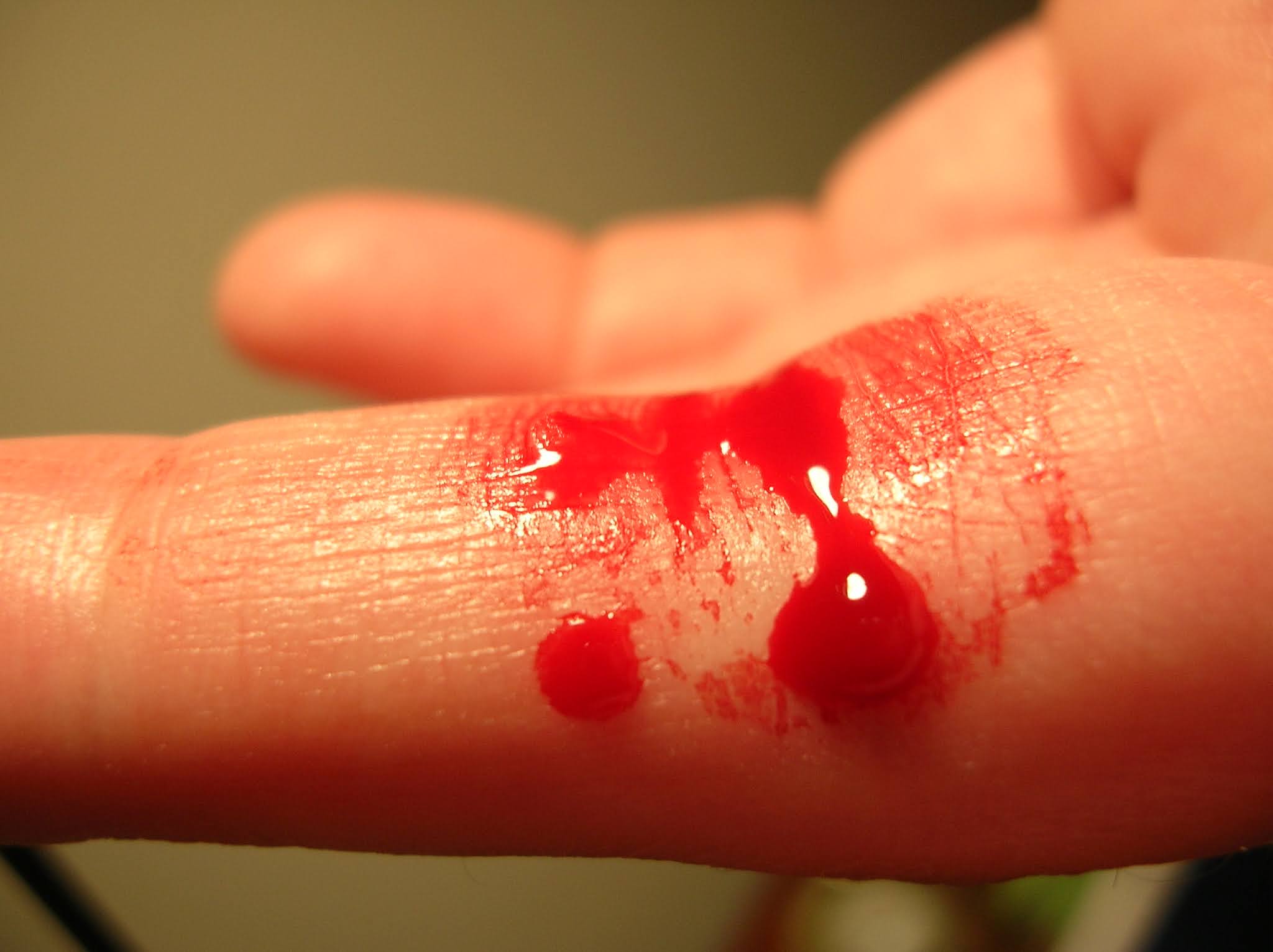 Homeopathic medicines stop all types of bleeding Life Homeo Care Clinic & scene care center